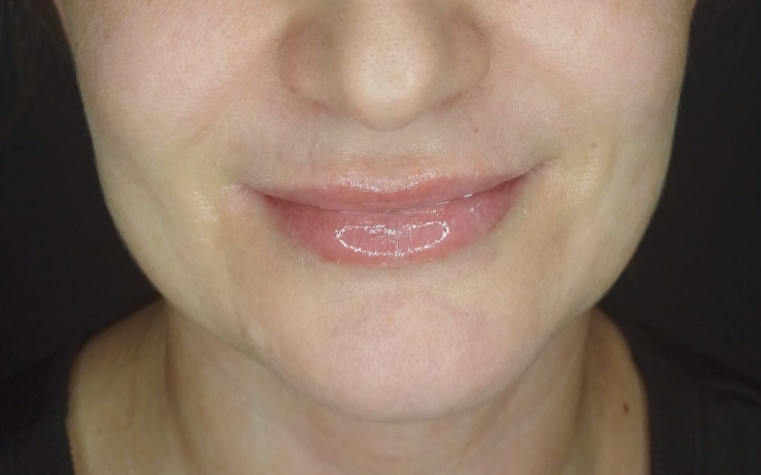 Preenchimento Labial: Estética Facial